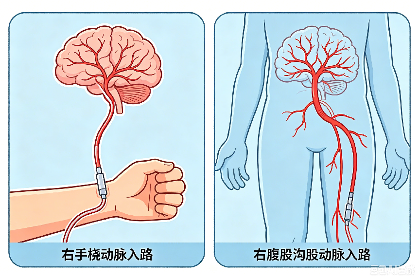 压迫器示意图