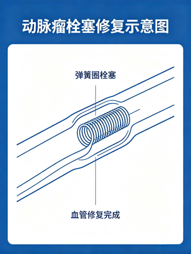 栓塞治疗示意图